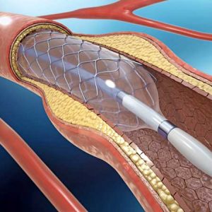 angioplastia-cateterismo